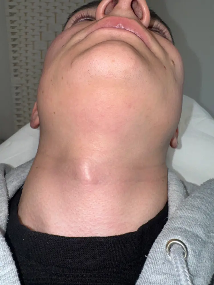 Hals voor behandeling